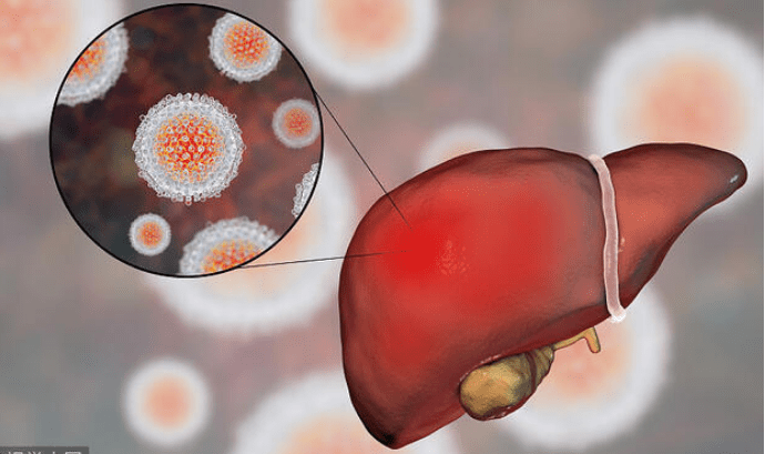 生活|肝硬化的“祸源”被揪出！肝不好的人，这4个行为习惯，趁早戒掉
