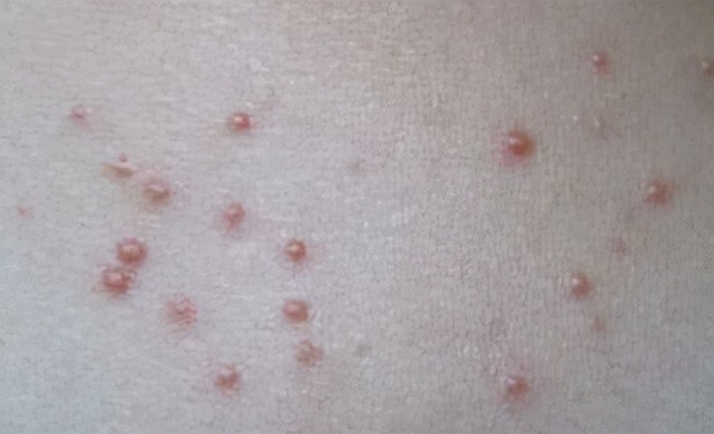 hpv感染的痘痘图片图片