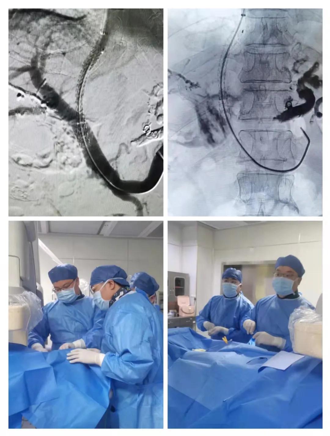 栓塞|西安市第三医院消化内科常年开展高难度介入TIPS术解决患者大难题