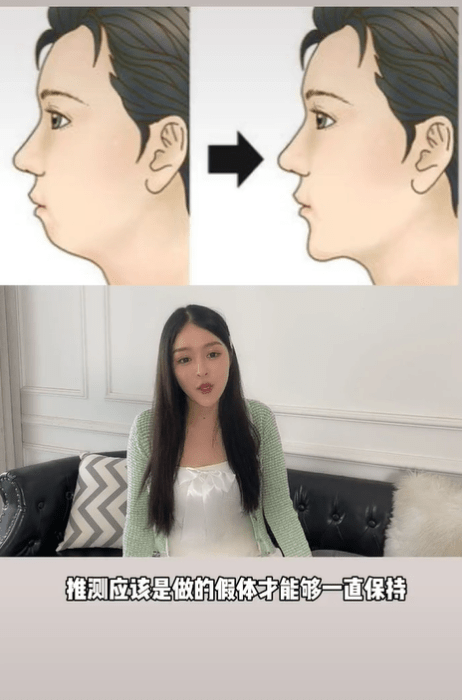分析鞠婧祎被质疑整容！医美博主称其是硅胶隆鼻填充脂肪最成功案例