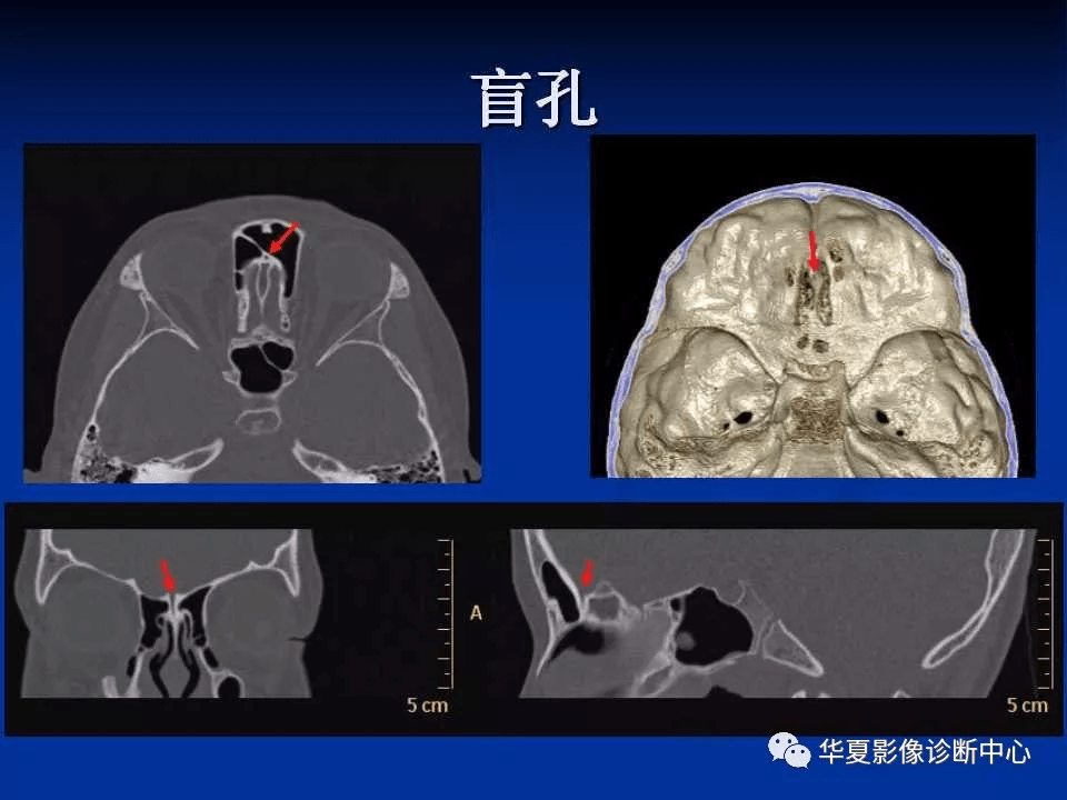 實用,詳細的顱底各孔道影像解剖!_結構_動脈_神經