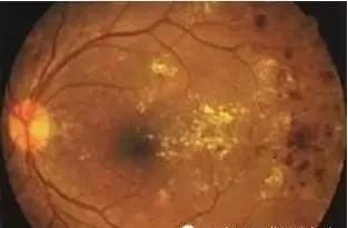 并发症|糖尿病科普知识