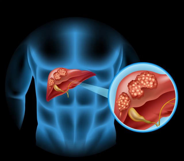 睡眠|不论男女，发现脸上有4种变化，小心肝已“变硬”，及时做检查