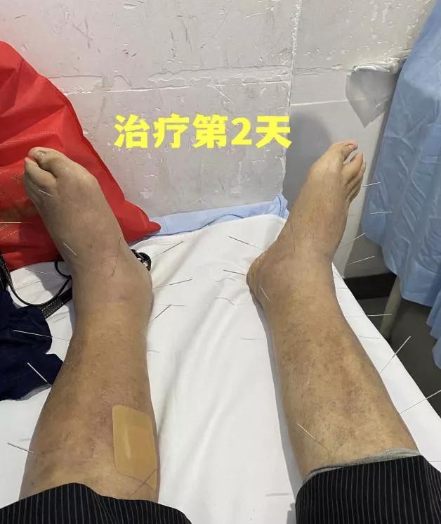 安军明主任医师针灸治疗心源性水肿一则_万大爷_患者_症状