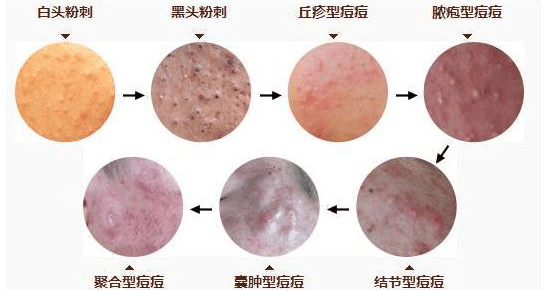 毛囊“换季就变丑”？容貌焦虑的我有多难，你知道吗~