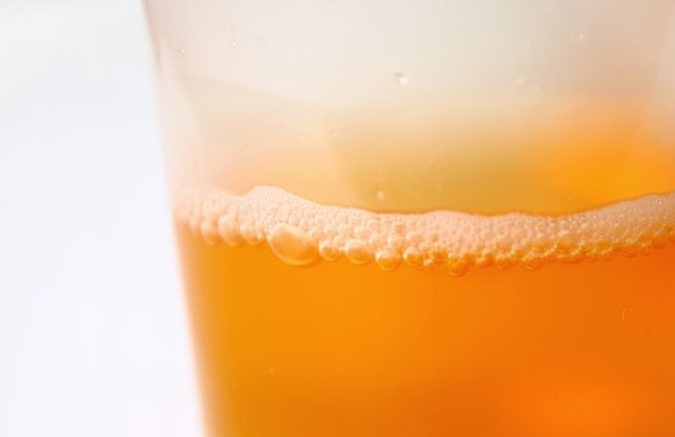 关键|得了肾结石,管住嘴是关键:少吃2类食物,防止结石变大