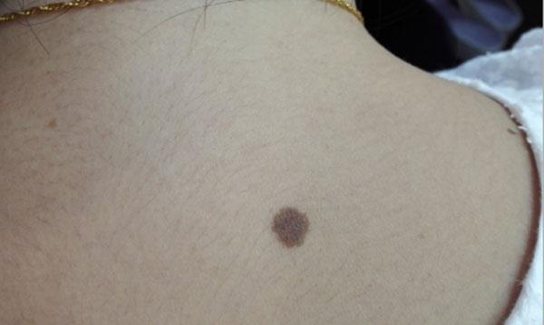 變化|得了肝硬化，身體會有啥反應？若有“一黃一腫一變”，盡早檢查下