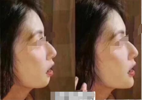 下巴明星的N种“假下巴”，尖到戳死人，翘成老巫婆，一个比一个怪异