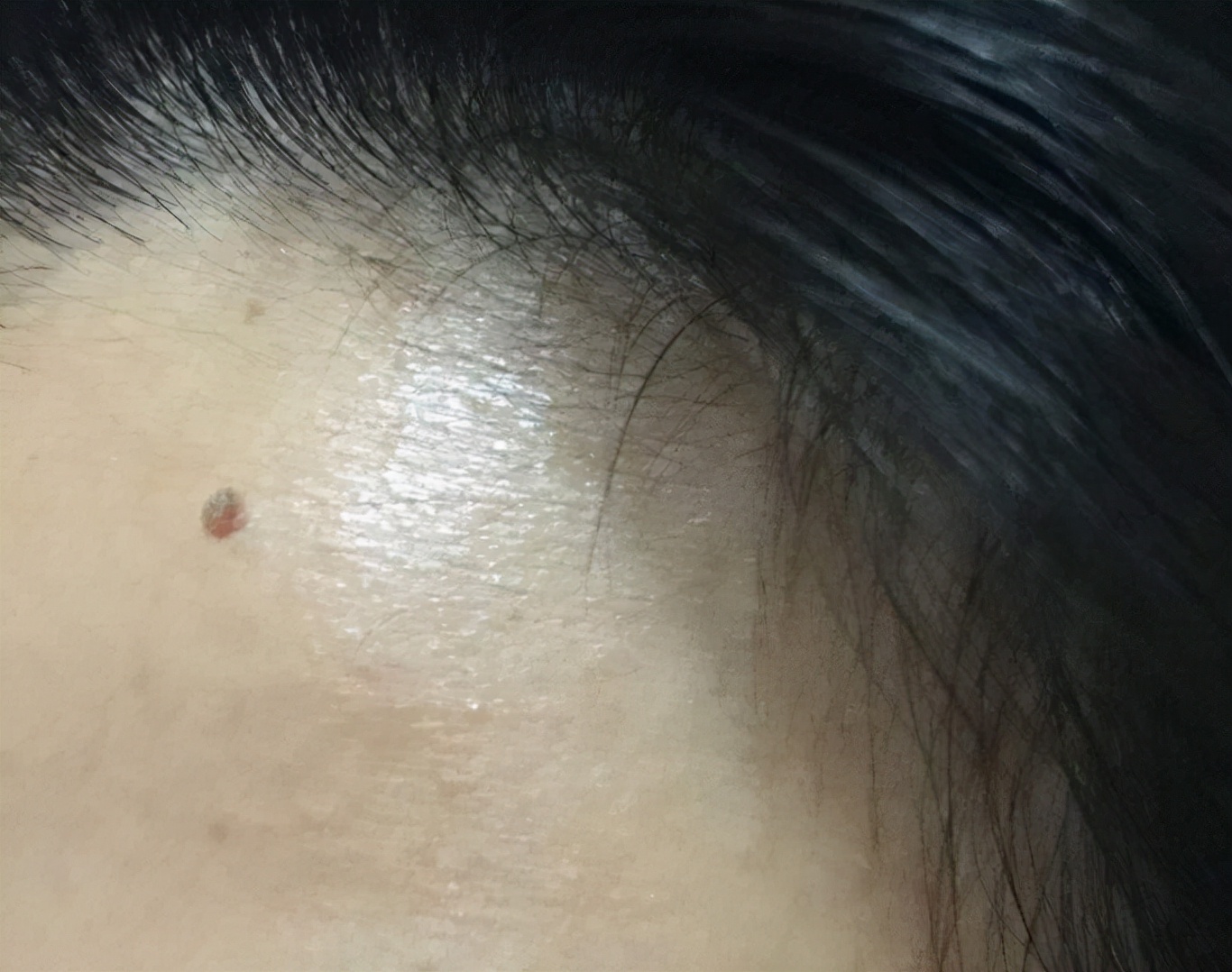 十有八九是感染hpv的,一眼就看得出来_免疫力_病毒_疙瘩