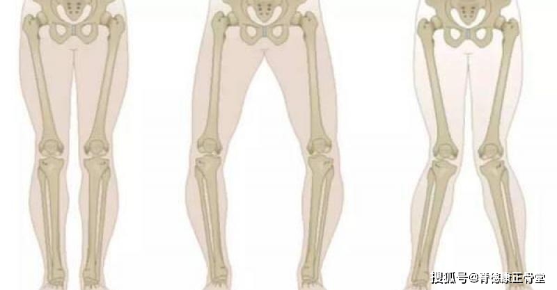 xo型腿正骨有用吗可通过以下方法矫正