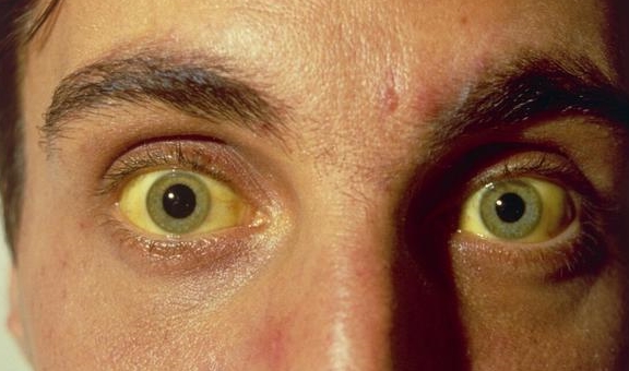 脸部|肝好不好看看脸就知道，若脸部出现4种现象，警惕肝可能发生病变