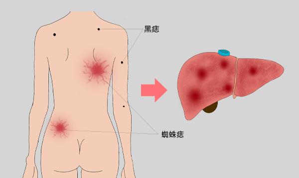 肝脏|肝病不是悄悄到访，身体早有先兆，若能早点发现，肝脏还有得救