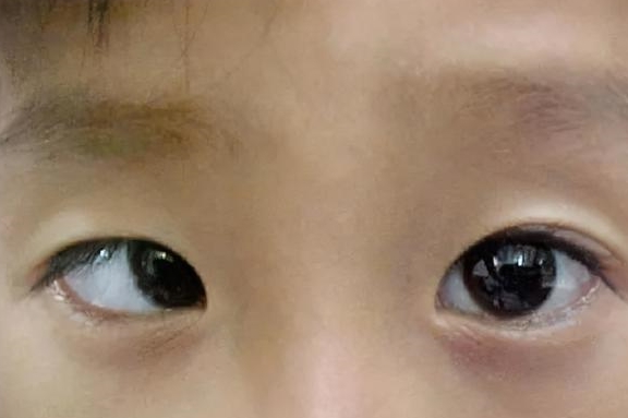 "斗鸡眼"专业术语是内斜视,有的孩子是一只眼睛斜,有的是两只眼睛都斜