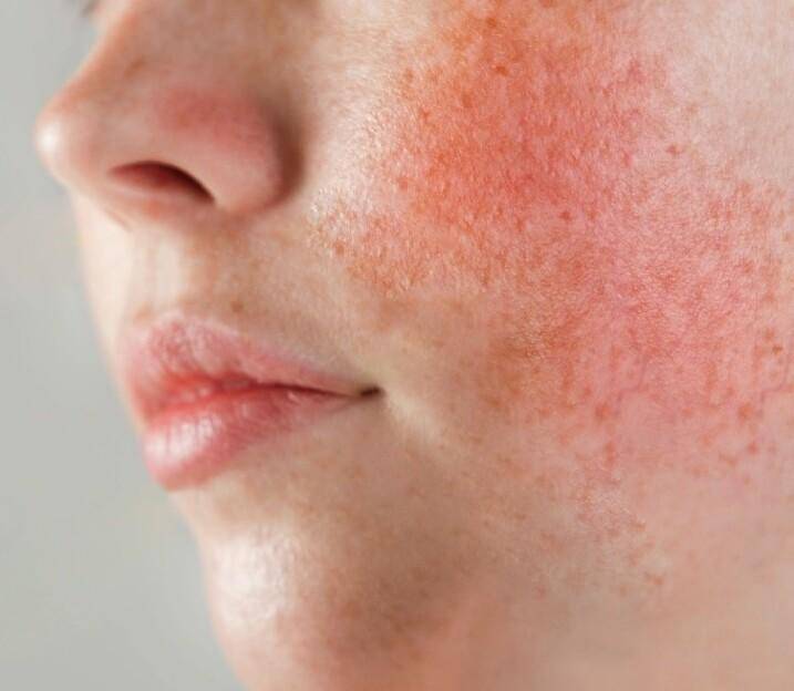 原创用护肤的时候皮肤刺痛不一定是皮肤太缺水