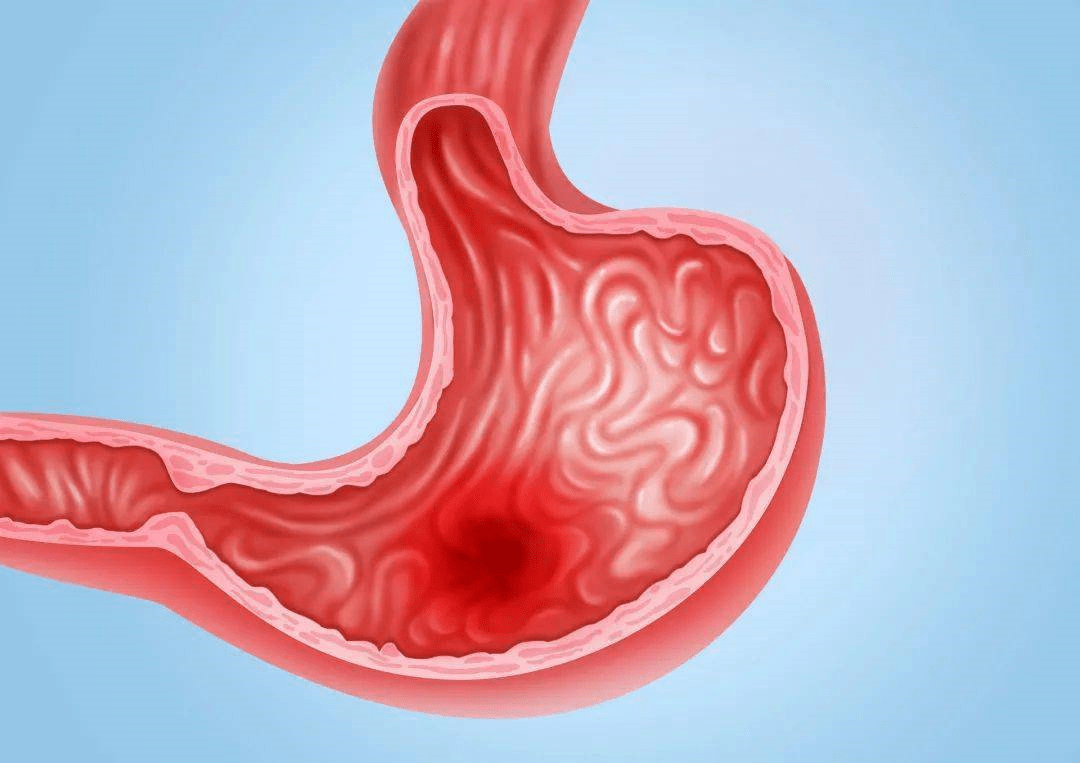 其次,胃溃疡是位于贲门至幽门之间的慢性溃疡,主要指胃黏膜被胃消化液