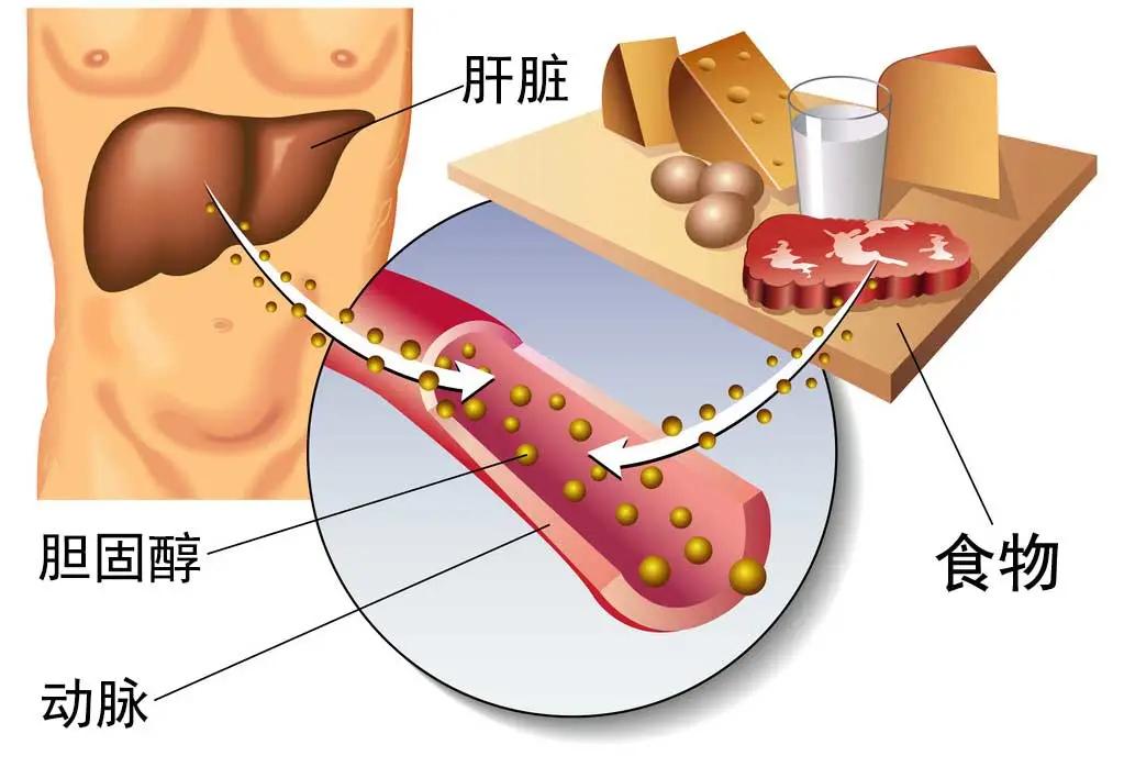 他汀|心脑血管专家虞桂博士：冠心病患者长期服用他汀类药物，血脂还不达标怎么办？