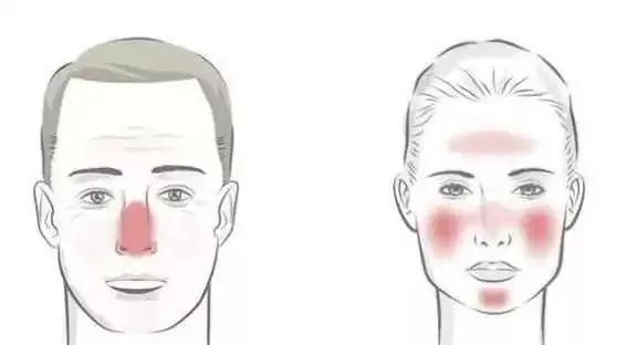 红斑脸部皮肤干燥、发红或敏感是咋回事？