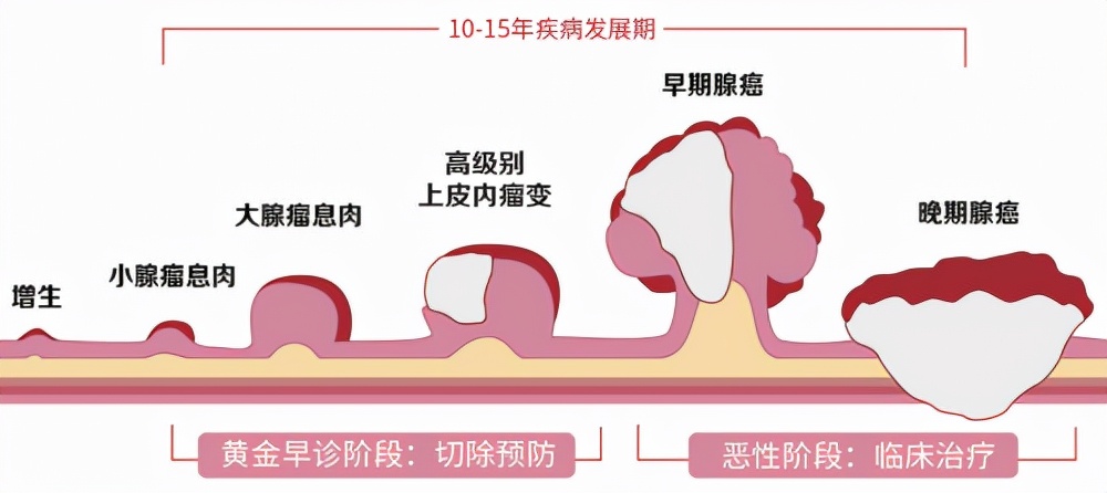 专家告诉你什么样的息肉会癌变,如何预防?