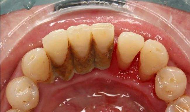 牙龈炎和牙周炎 , 区别究竟在哪里?_治疗_发展_症状