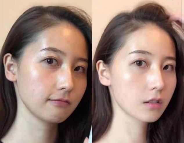 黑头李佳琦分享自用“祛痘膏”价格才几十，祛痘效果却让人拍案叫绝！