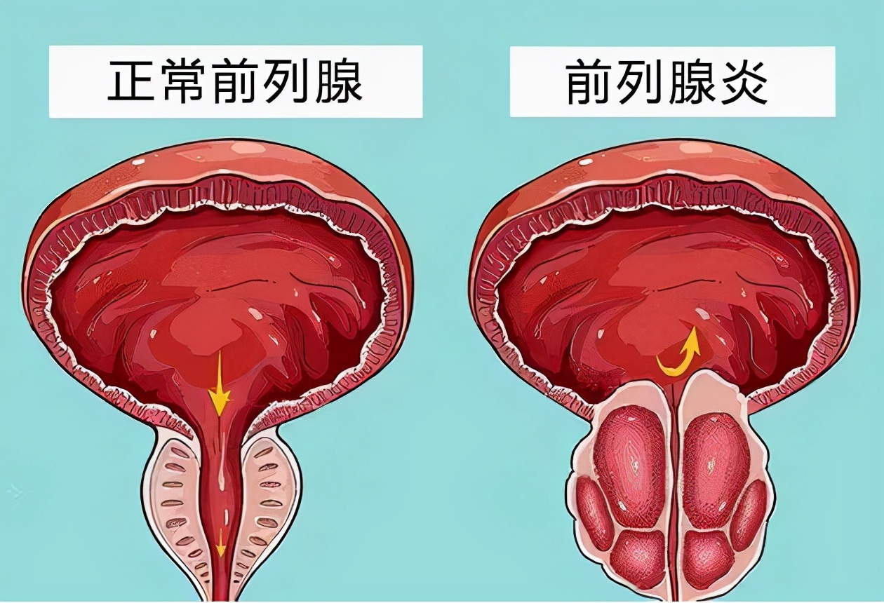 漫画科普第一课：上海五院泌尿外科医生与你说说前列腺那些事|上海五院|前列腺癌|直肠指检|恶性肿瘤|前列腺|漫画|泌尿|-健康界