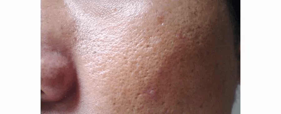 人群嘉玲护肤老师：毛孔粗大怎么破