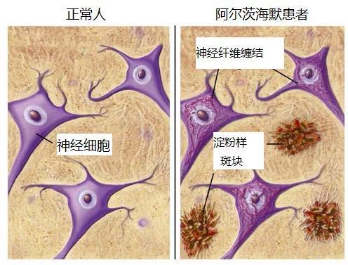 症状|阿尔茨海默病——脑中的橡皮擦，擦掉记忆，最后脑中只剩一片空白