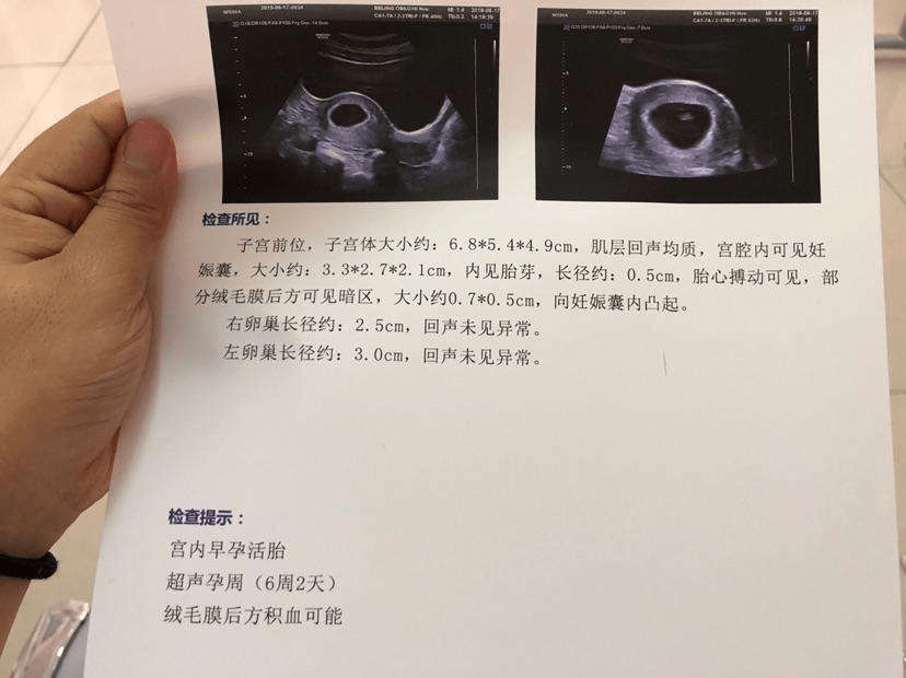 怀孕彩超照片初期图片