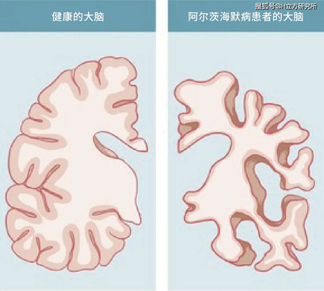 关注阿尔茨海默病:知彼知己,早诊早智!_疾病_患者_大脑