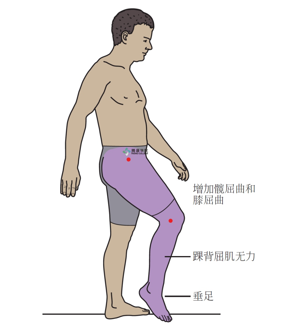 拖把|【读报】怪异步态暗藏健康危机