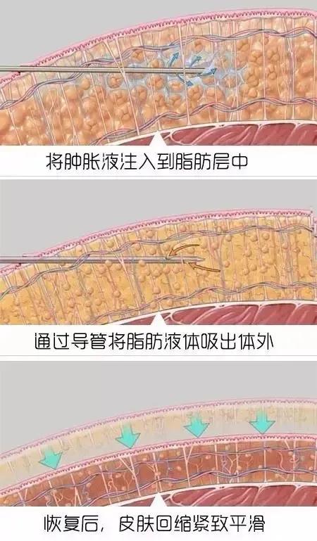 捷径李波主任：吸脂这条捷径，真能实现轻松「躺赢」吗？