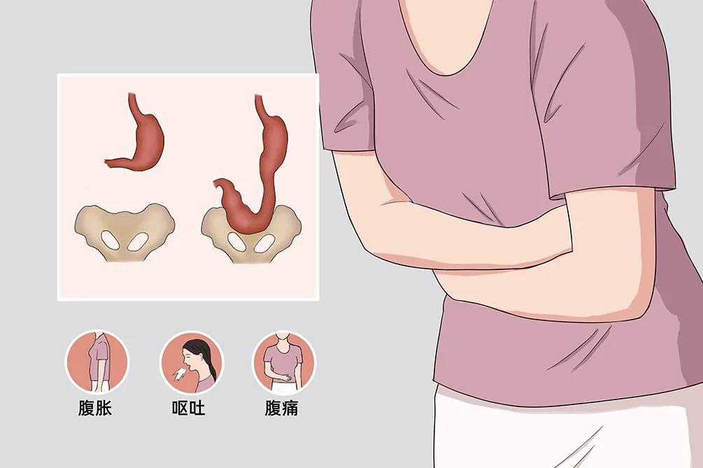 什么是胃下垂?
