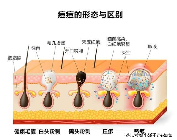 脸部别再用手挤痘痘了，痘痘肌的护肤经验今天我都帮你总结全了！