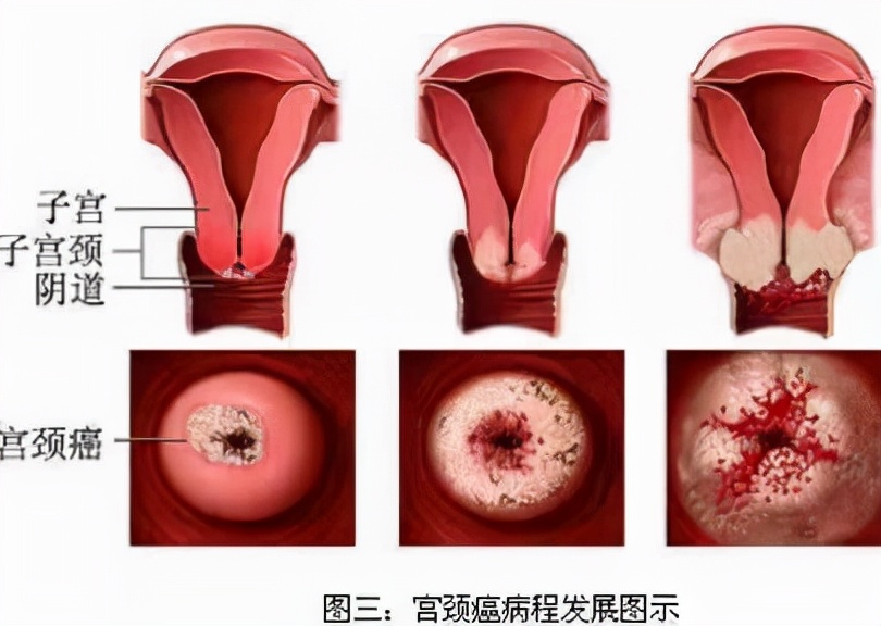 3,腺鳞癌这种类型的癌多发生在宫颈管,占15%~20%