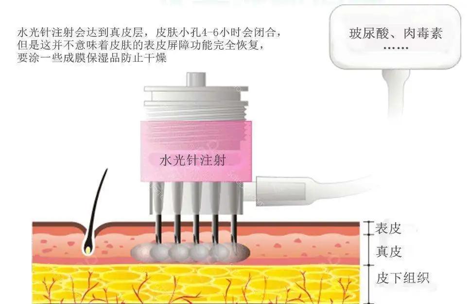 因为郭金月主任：光子嫩肤痛一点还是水光针痛一点？