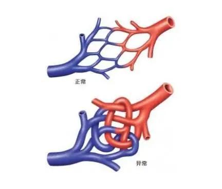 畸形|当11岁女孩巧遇这对“缠绵恋人” 看神经外科专家如何一招制胜