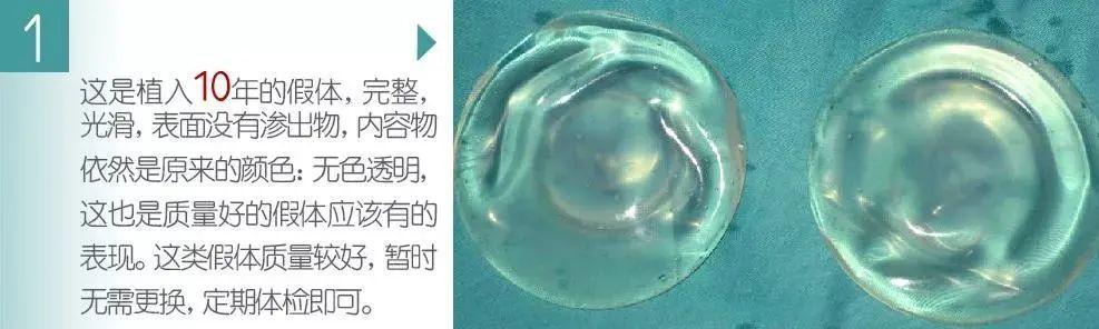 郭广科济南韩氏郭广科：隆胸假体长期植入有没有危害