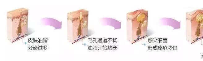 长痘痘银幕上的明星们为什么肌肤那么光洁？