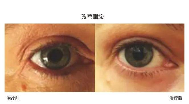 美容|Fotona4D美容 云南铜雀台杨才华讲解Fotona 4D Pro