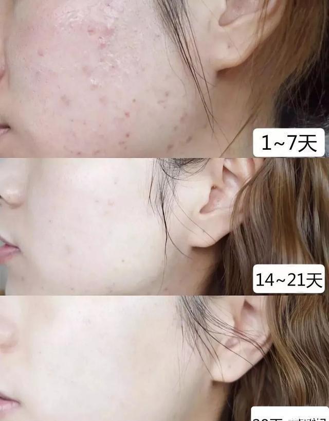 毛孔王源脸上痘痘越发严重，众人呼吁让他戒烟，美颜滤镜都救不了