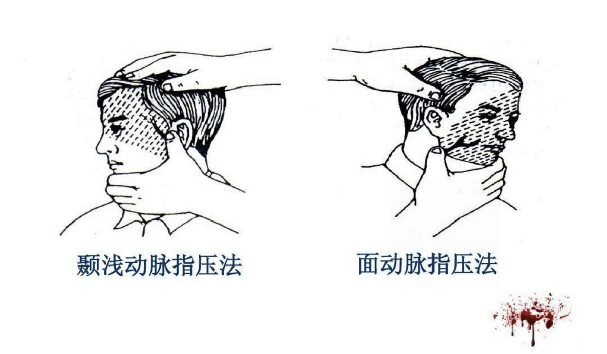 指压止血法示意图图片