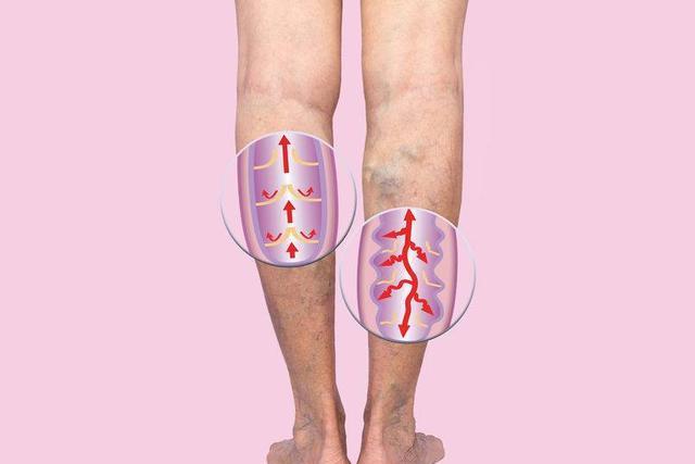 症状|体内血糖高，腿部先遭殃！若腿脚出现3个异样，最好做个血常规