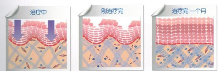于超声老司机：做超声刀有效果吗？做过超声刀后的保养核心在这里~