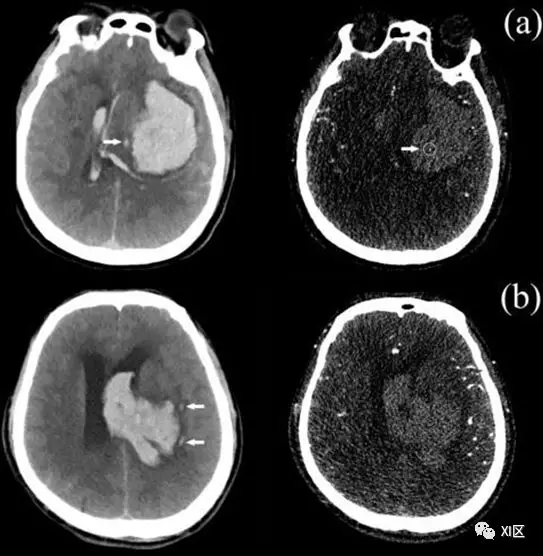 ct圖像中腦出血血腫擴大的十個徵象上