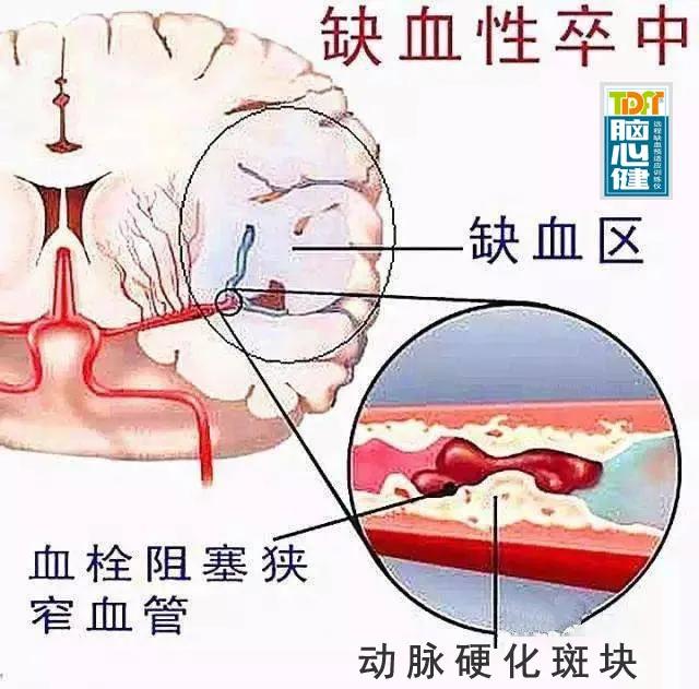 70%以上卒中患者会致残 33%卒中患者五年内易复发