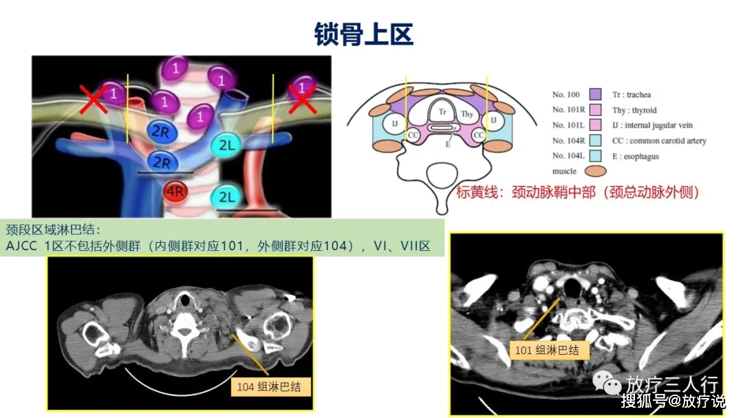 原创同与异黄伟黄勇教授uiccajccjes协会的肺癌食管癌淋巴结分区