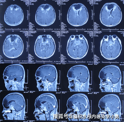 头颅ct报告模板图片