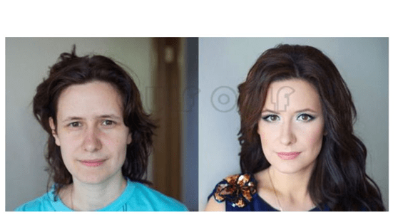 能量求解:蛋白线真的能去皱纹吗,为啥线雕完三个月脸又松弛了?