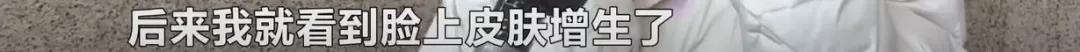 维权长沙一女子花5000元祛斑后懊恼被“毁容”，工作人员：正常现象