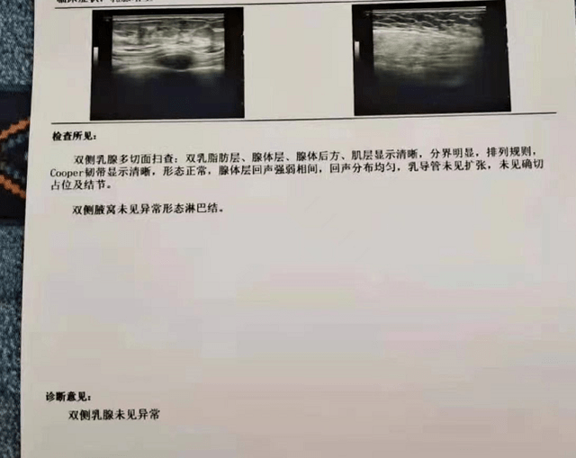 医案分享切不尽的多发性乳腺结节经中医调理3个月自动消散